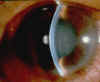 glaucoma.jpg (10384 バイト)